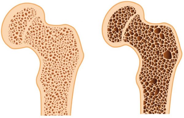 What is Russian Caravan tea? 13 osteoporosis